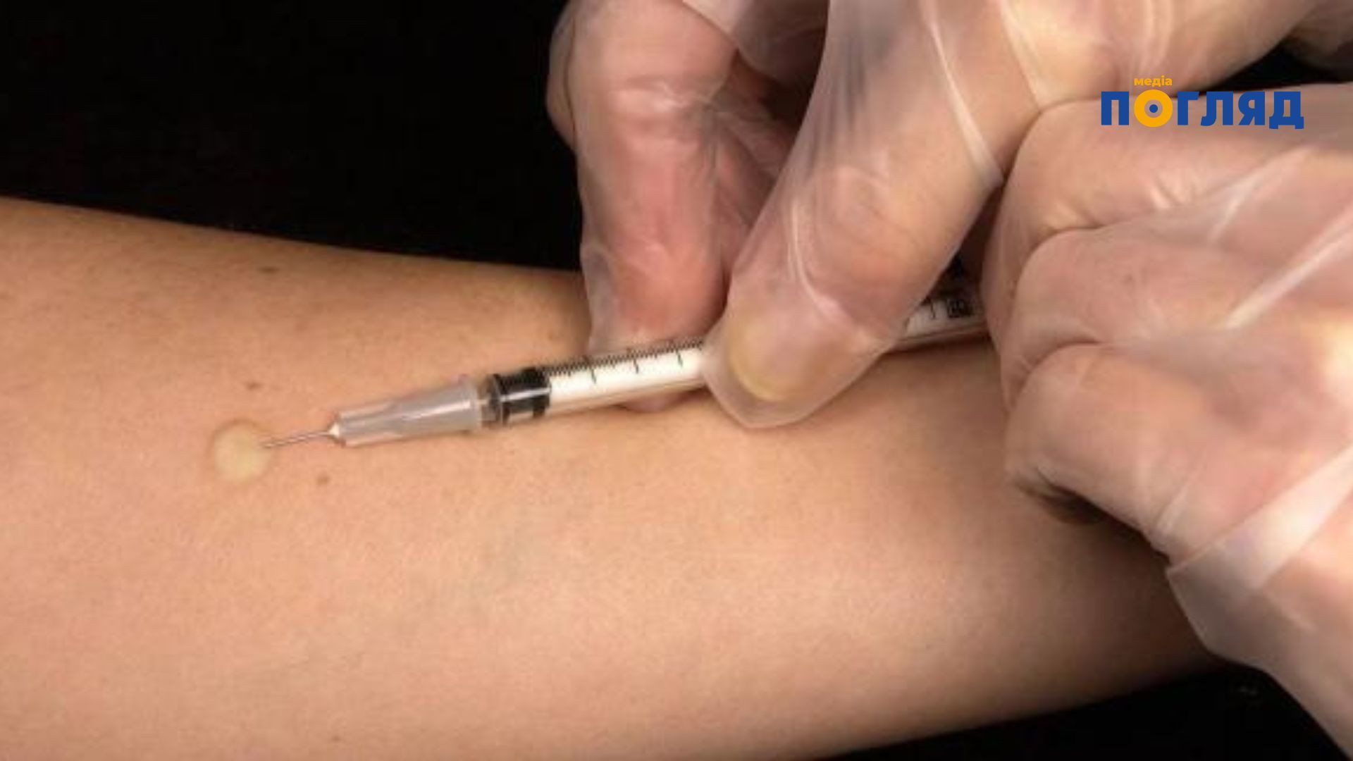 В Україні змінюють методи діагностики туберкульозу: що прийде на зміну пробі Манту (ФОТО) - зображення